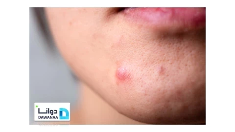 حب الشباب  ACNE  مشكلة تؤرق الشباب من الجنسين