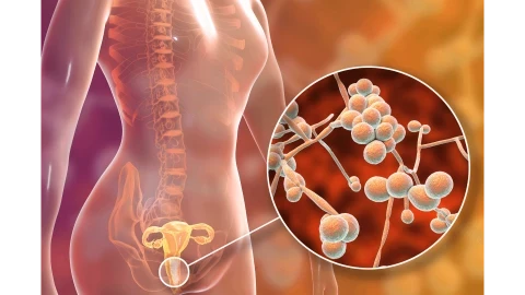 تعرفي على العدوى الفطرية المهبلية وطرق علاجها