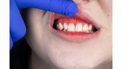 تعرف علي اعراض التهاب اللثة (Gingivitis)