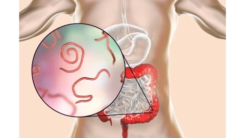 الديدان الخيطية (الدبوسية)من اشهر أمراض الأطفال الشائعة
