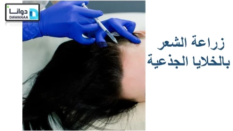 زراعة الشعر بالخلايا الجذعية